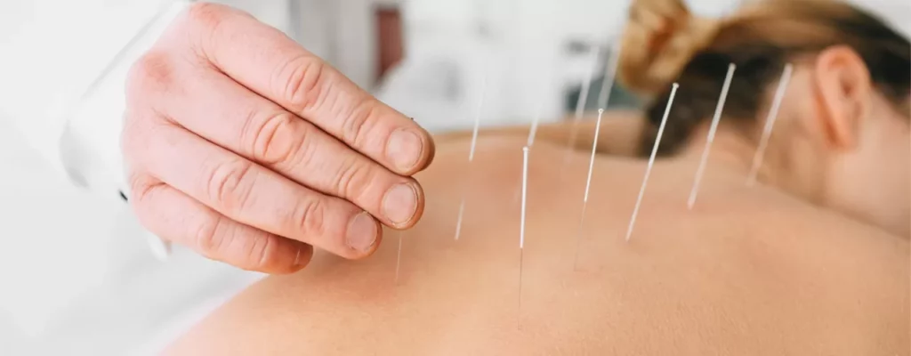 L'Acupuncture : Définition, Bienfaits et Indications