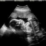 À quel moment effectuer une échographie quand on est enceinte ?