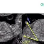 Comment Lire une Échographie pour Déterminer le Sexe du Bébé : Fille ou Garçon ?