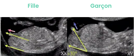 Comment Lire une Échographie pour Déterminer le Sexe du Bébé : Fille ou Garçon ?