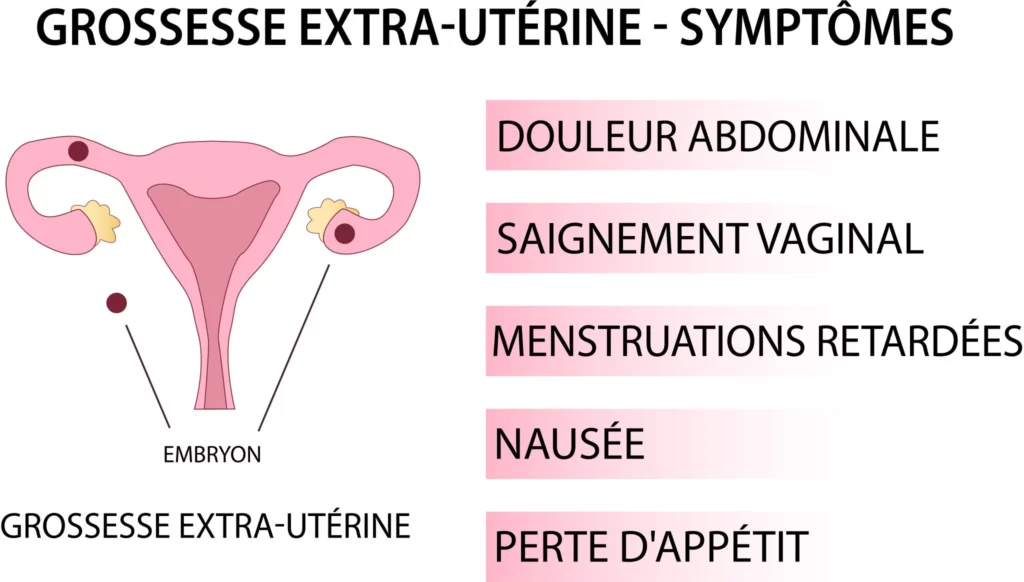 Les Signes de la Grossesse Extra-Utérine