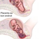 Placenta prævia : Comprendre cette complication de grossesse