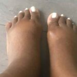 Pieds Gonflés Pendant la Grossesse : Quand S’inquiéter ?