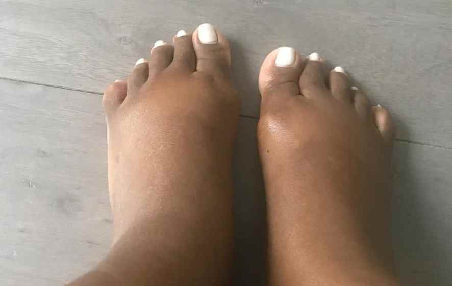 Pieds Gonflés Pendant la Grossesse : Quand S’inquiéter ?