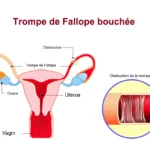 Trompes de Fallope Bouchées : Causes, Symptômes et Solutions