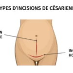 25 Témoignages de femmes sur la césarienne