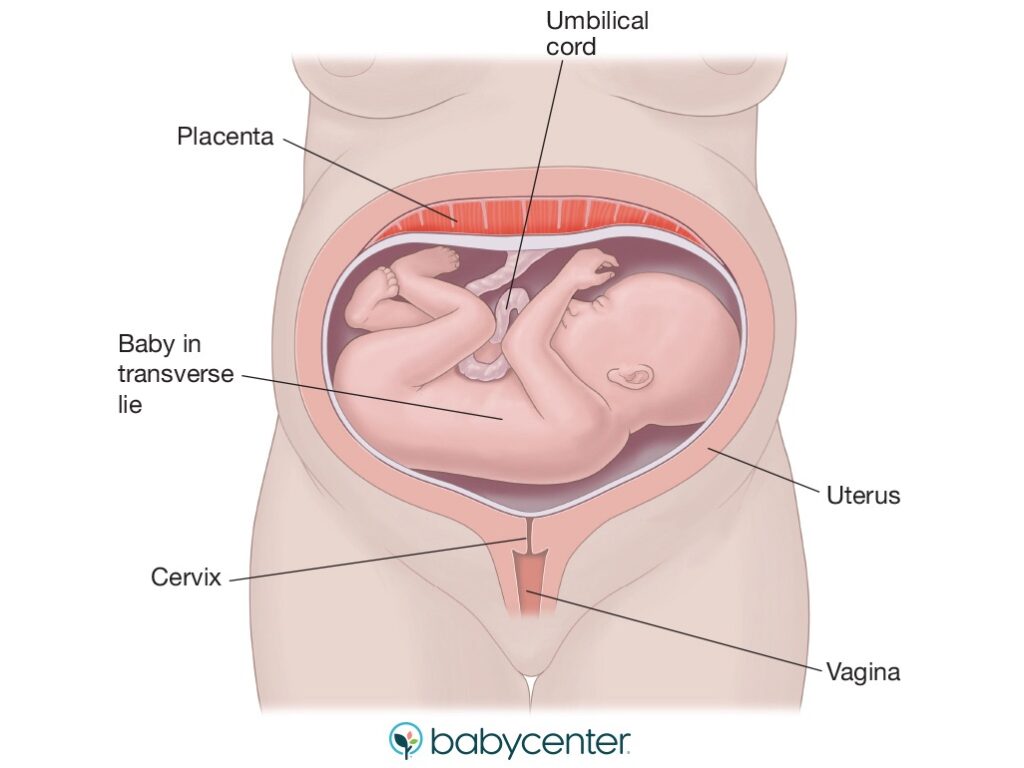 Pourquoi mon bébé est en transverse ?