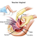 Toucher vaginal : Tout savoir sur cet examen gynécologique