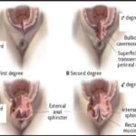Déchirures d&rsquo;accouchement : Quand tombent les fils ?