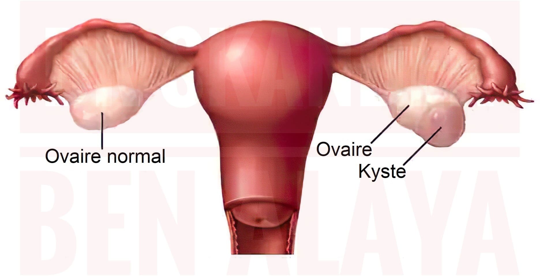 Les Kystes de l’Ovaire : Causes, Symptômes et Traitements