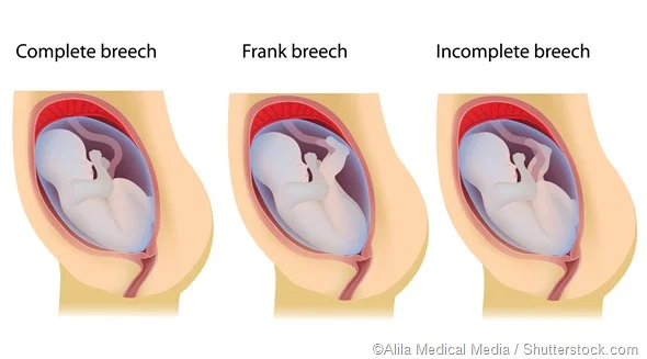 Can You Give Birth Vaginally If Your Baby Is Breech? 