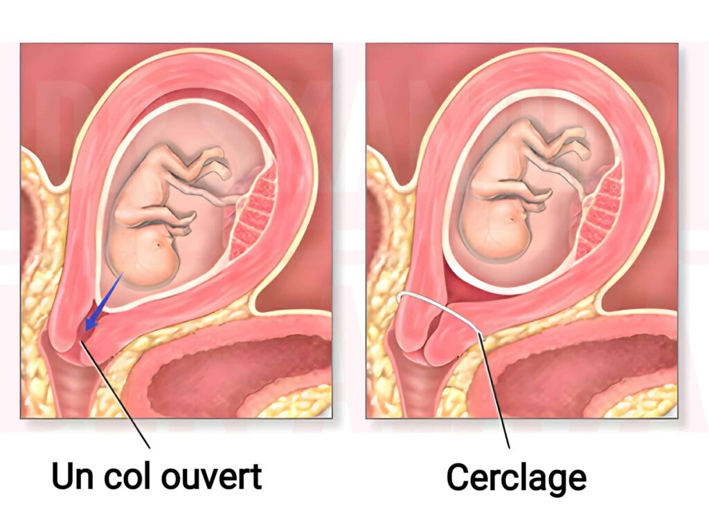 Le col peut-il s’ouvrir malgré un cerclage ?  