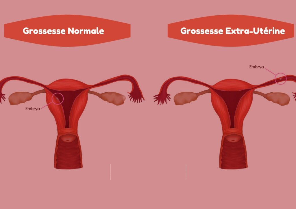 Qu’est-ce qu’une grossesse extra-utérine et comment la détecter ?