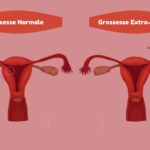 Qu’est-ce qu’une grossesse extra-utérine et comment la détecter ?