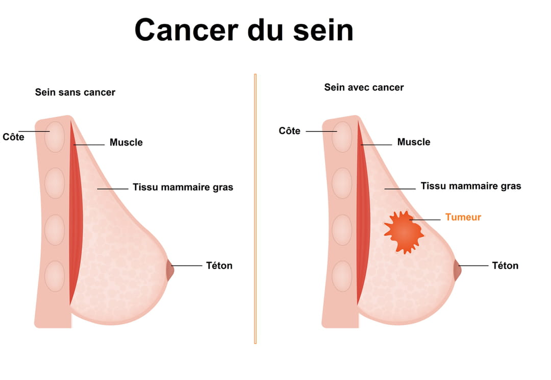 Les différents types de cancer du sein et leurs traitements