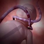 La circulaire du cordon : causes, conséquences, diagnostic et prise en charge