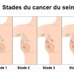 Comment faire l’auto-examen des seins chez soi ?