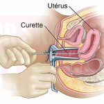 Tomber enceinte juste après un curetage : est-ce dangereux ?